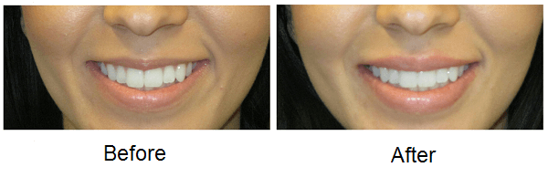 Galderma Fillers - A before and after picture of a woman 's smile