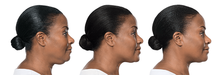 Allergan Fillers- Before and after photo of woman's chin