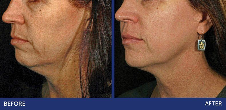 Photo of a woman 's face before and  after using SkinTyte