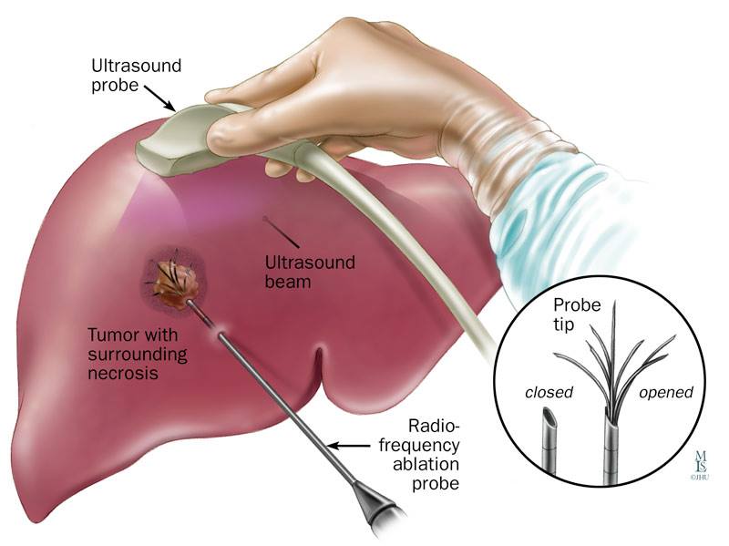 Illustration of ultrasound-guided radiofrequency ablation of a liver tumor