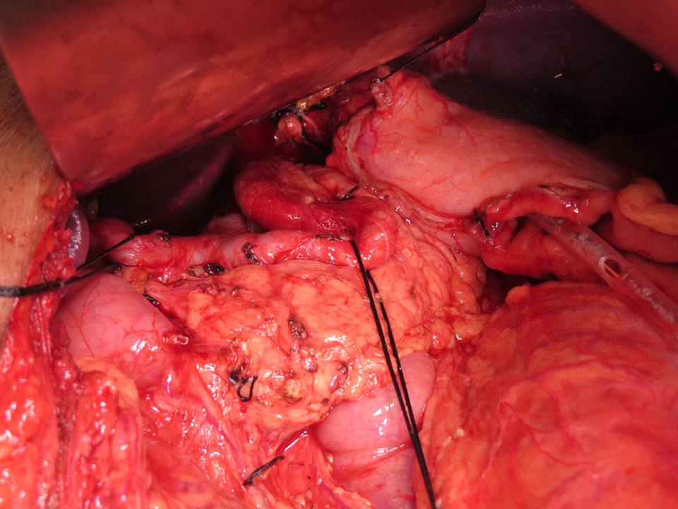 Intraoperative view of open abdominal surgery with exposed tissue and sutures
