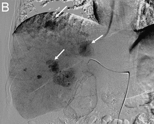 Angiographic image showing abnormal contrast areas highlighted by arrows