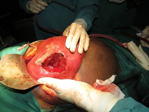 Open surgical procedure showing exposed tissue during operation
