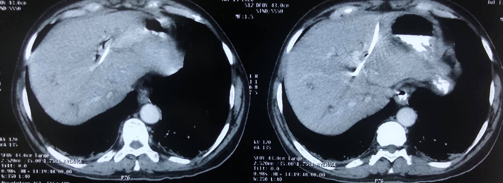 3A hilar cholangiocarcinoma (complex hepatobiliary malignancy) with deep jaundice