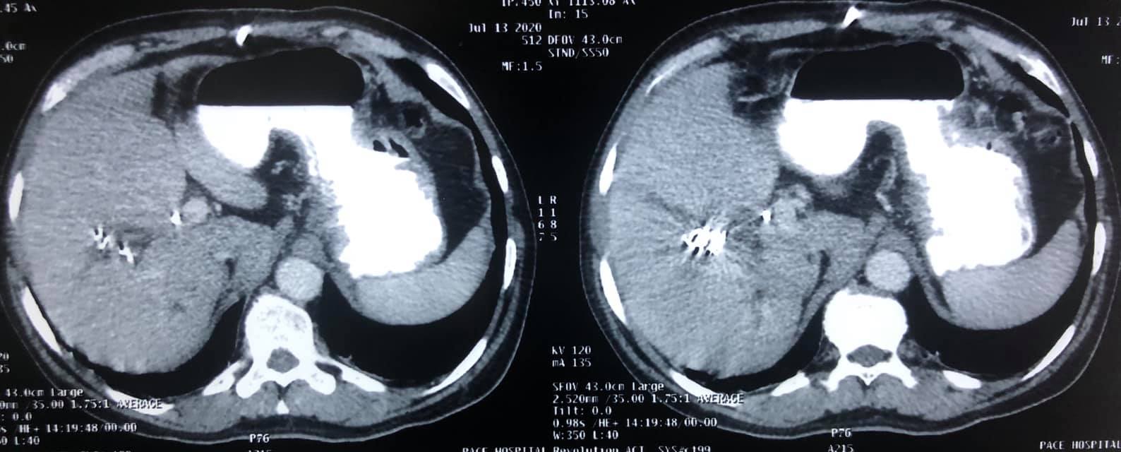 3A hilar cholangiocarcinoma (complex hepatobiliary malignancy) with deep jaundice