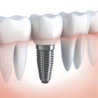 Dental Implant Dental Implant
