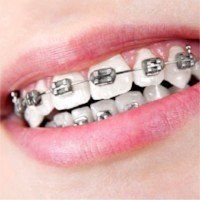 Teeth with Metal Braces Teeth with Metal Braces