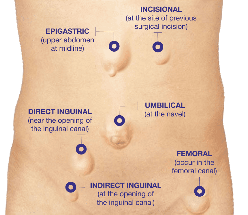 6 Common Types of Hernia | Best Hospitals for Hernia Surgery in Hyderabad, India types of hernia | hernia treatment in Hyderabad | best hospital for hernia surgery in Hyderabad India | best hospitals in Hyderabad for hernia surgery
