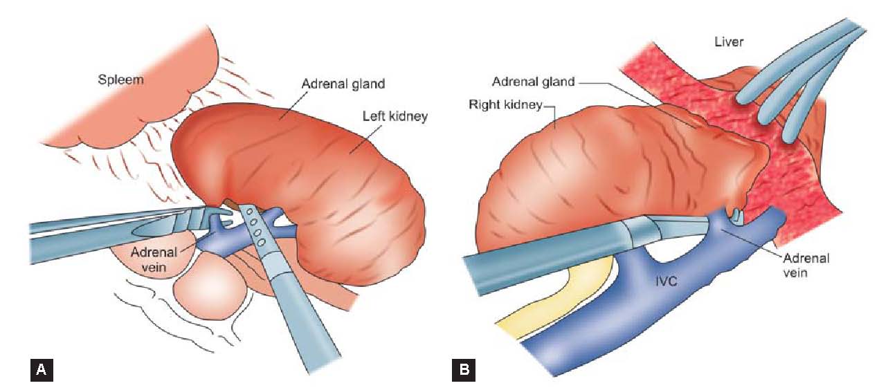 Left Laparoscopic Adrenalectomy Surgery Left Laparoscopic Adrenalectomy procedure in India