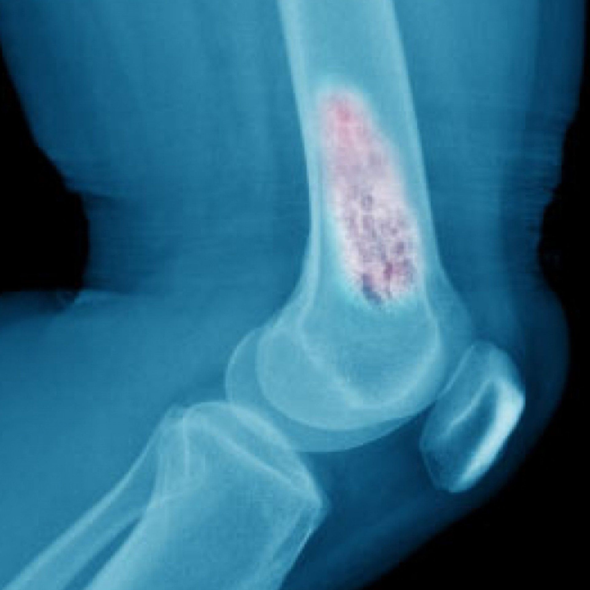 Bone cancer screening and diagnosis at PACE Hospitals Hyderabad