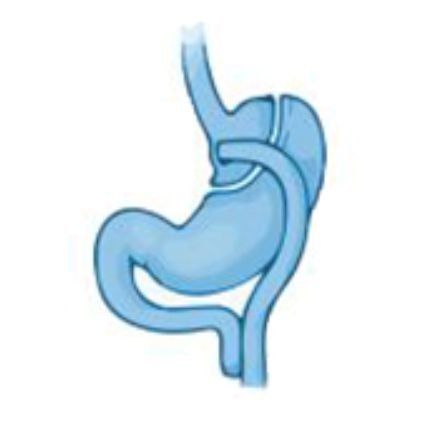 गैस्ट्रिक बाईपास | Gastric Bypass गैस्ट्रिक बाईपास | Gastric Bypass