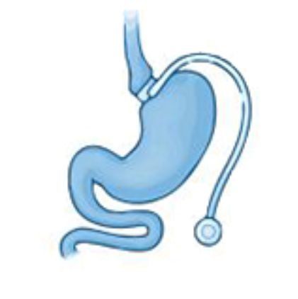 लैप बैंड/गैस्ट्रिक बैंडिंग | Lap Band/Gastric Banding लैप बैंड/गैस्ट्रिक बैंडिंग | Lap Band/Gastric Banding