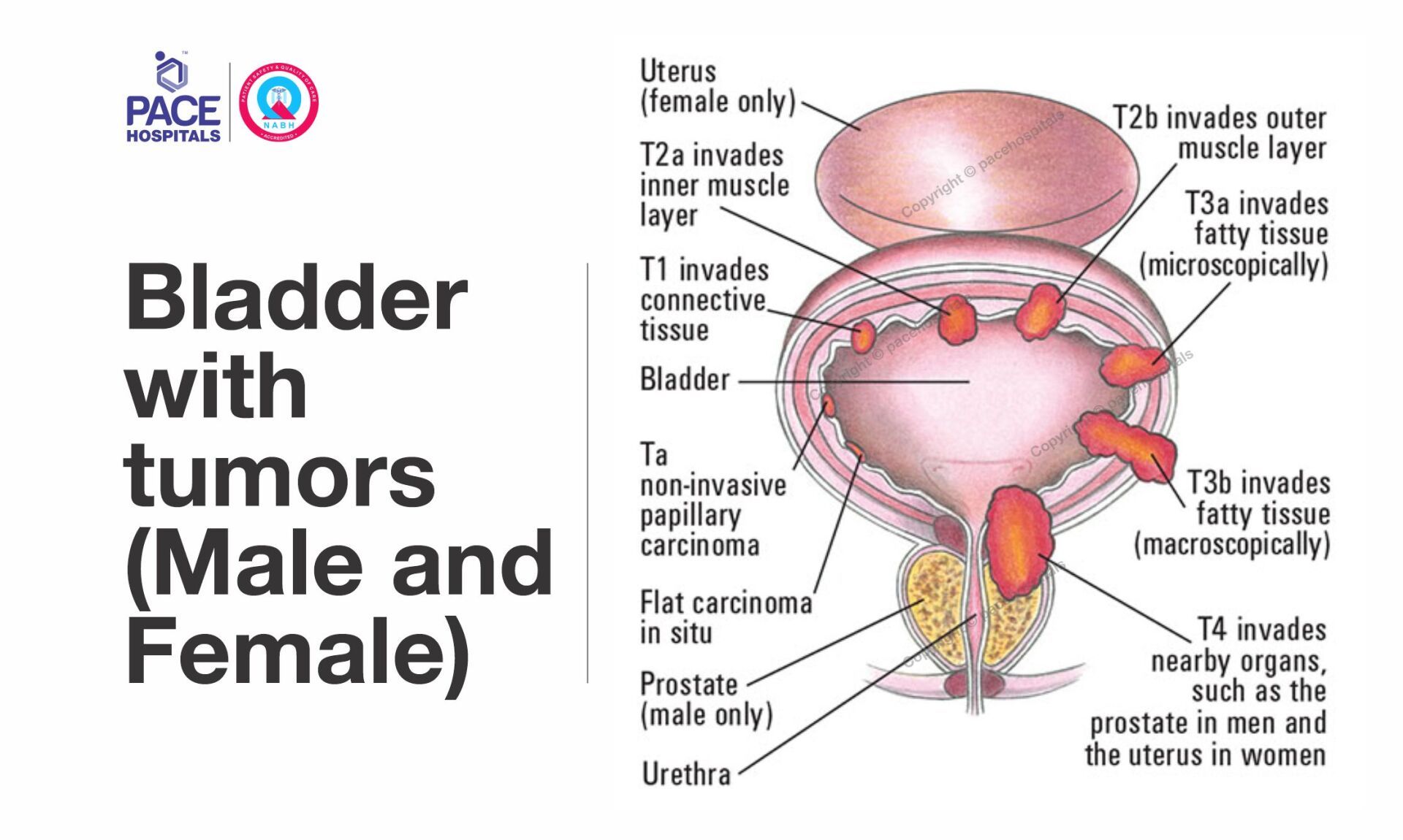 Bladder with tumors (Male and Female) Bladder with tumors (Male and Female)