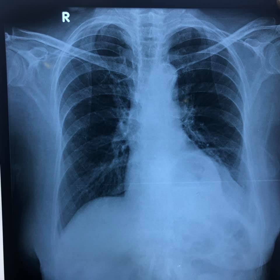 Image of Bochdalek Hernia