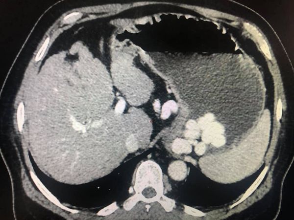 CLD with HUGE gastric varices uncontrolled