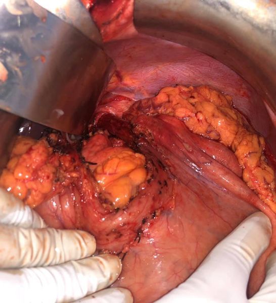 CLD with HUGE gastric varices uncontrolled