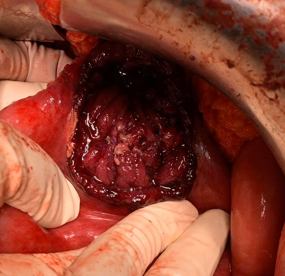 CLD with HUGE gastric varices uncontrolled