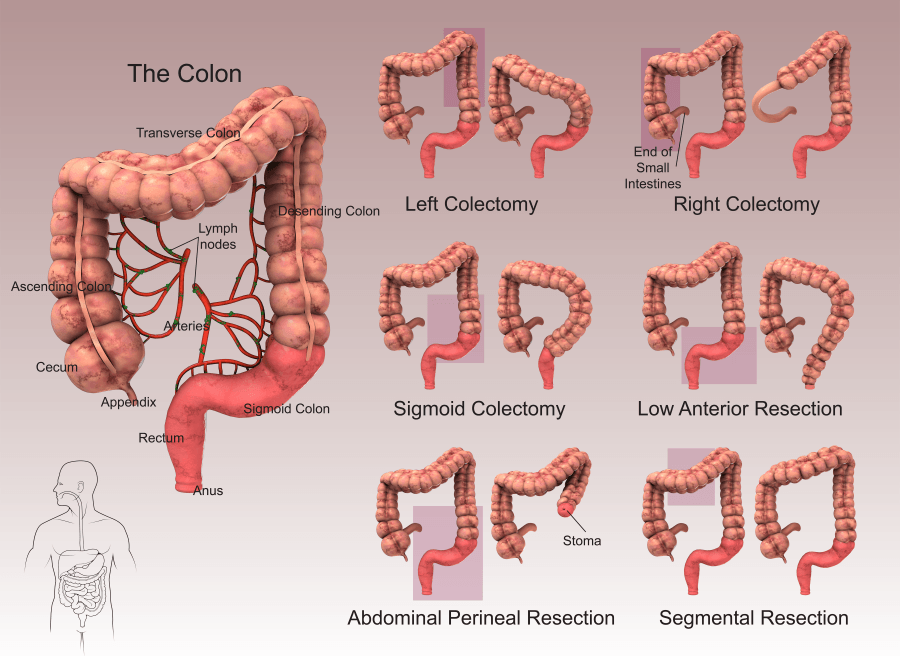 Partial Colectomy