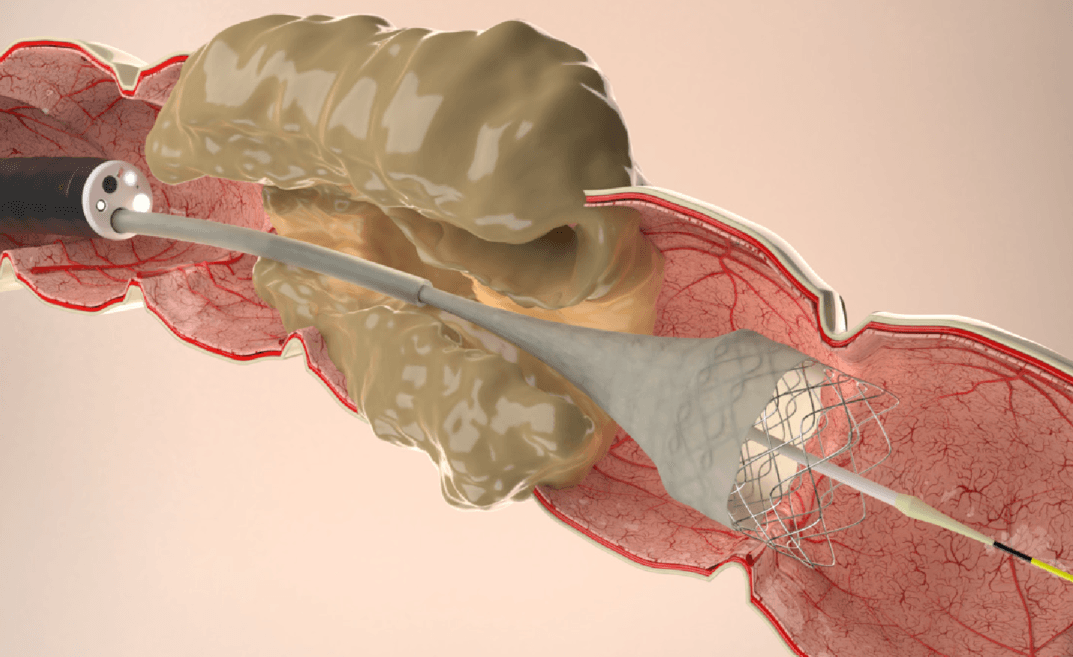 image depicting colonic metal stenting procedure