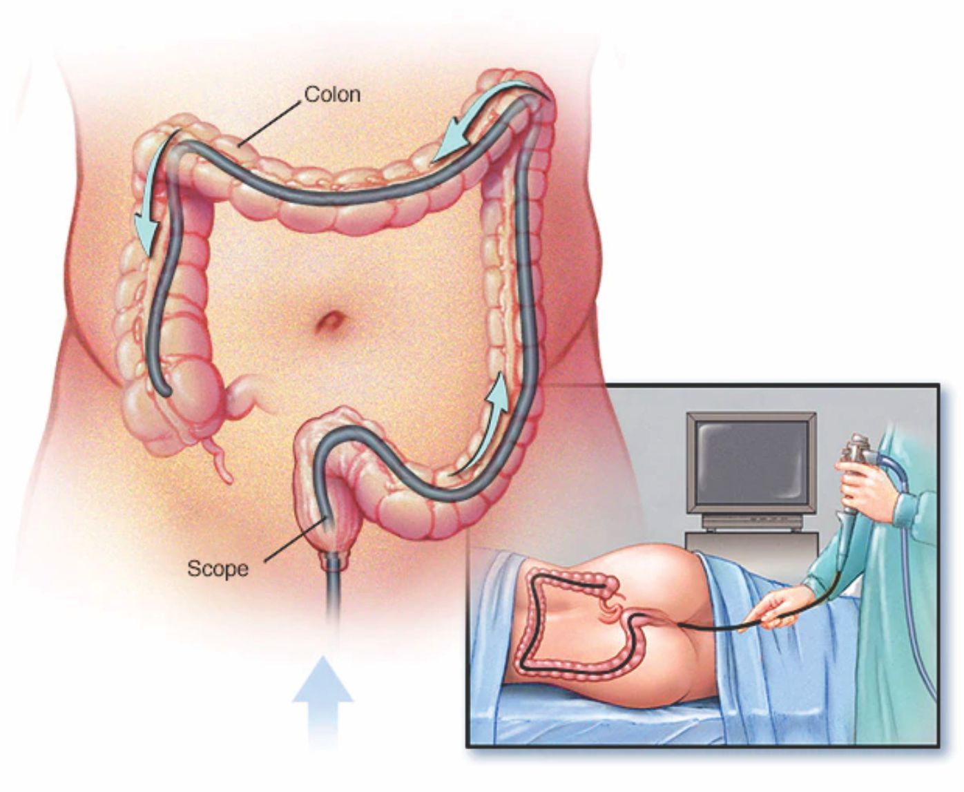 Colonoscopy Procedure, Purpose, Preparation and Cost in Hyderabad Colonoscopy Procedure, Purpose, Preparation and Cost in Hyderabad