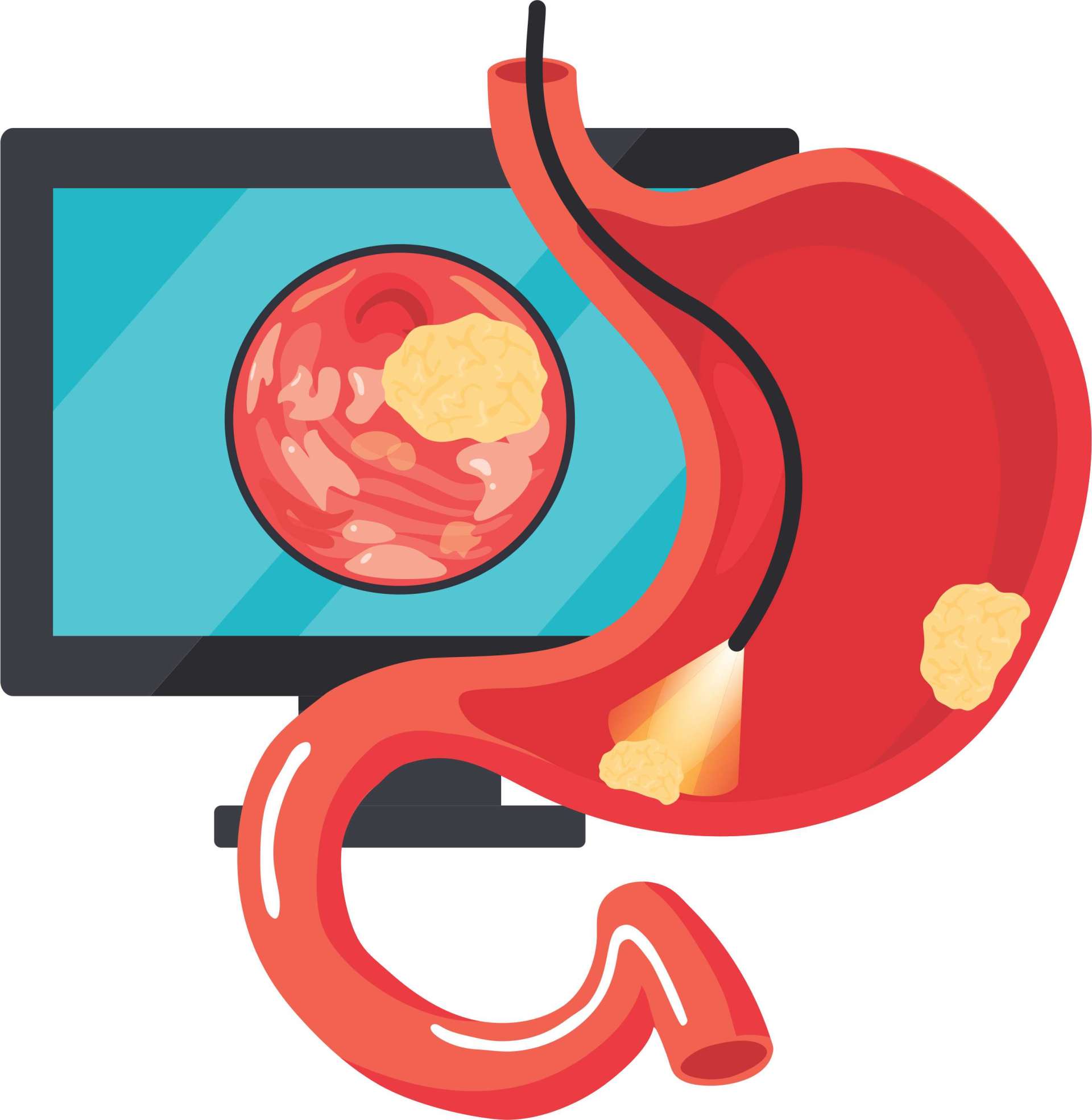 Upper GI Endoscopy Procedure, Purpose, Preparation, Cost in Hyderabad Upper GI Endoscopy Procedure, Purpose, Preparation, Cost in Hyderabad