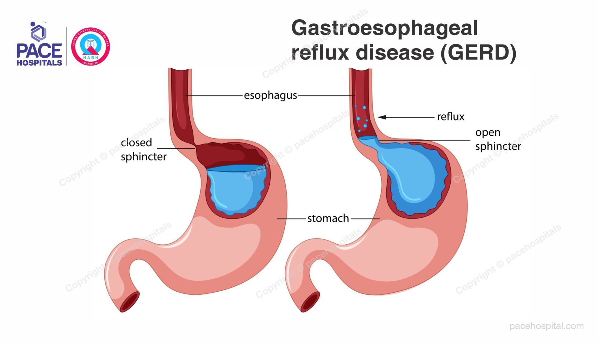 Gstroesophageal Reflux Disease (GERD) Gstroesophageal Reflux Disease (GERD)