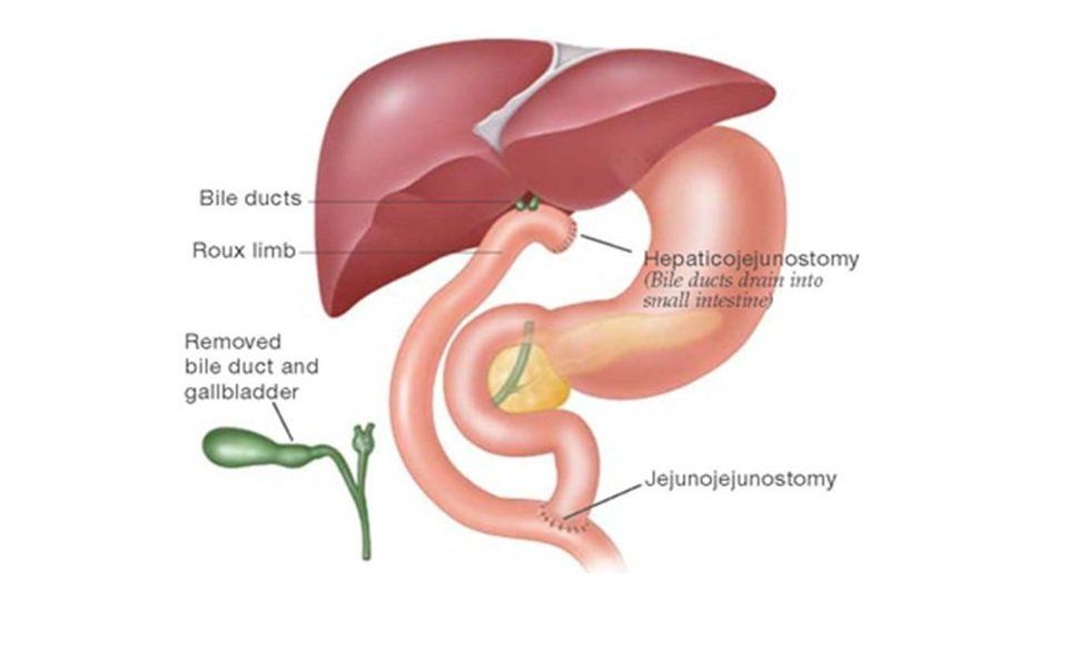 Hepatectomy Living Donor Right Hepatectomy Surgery