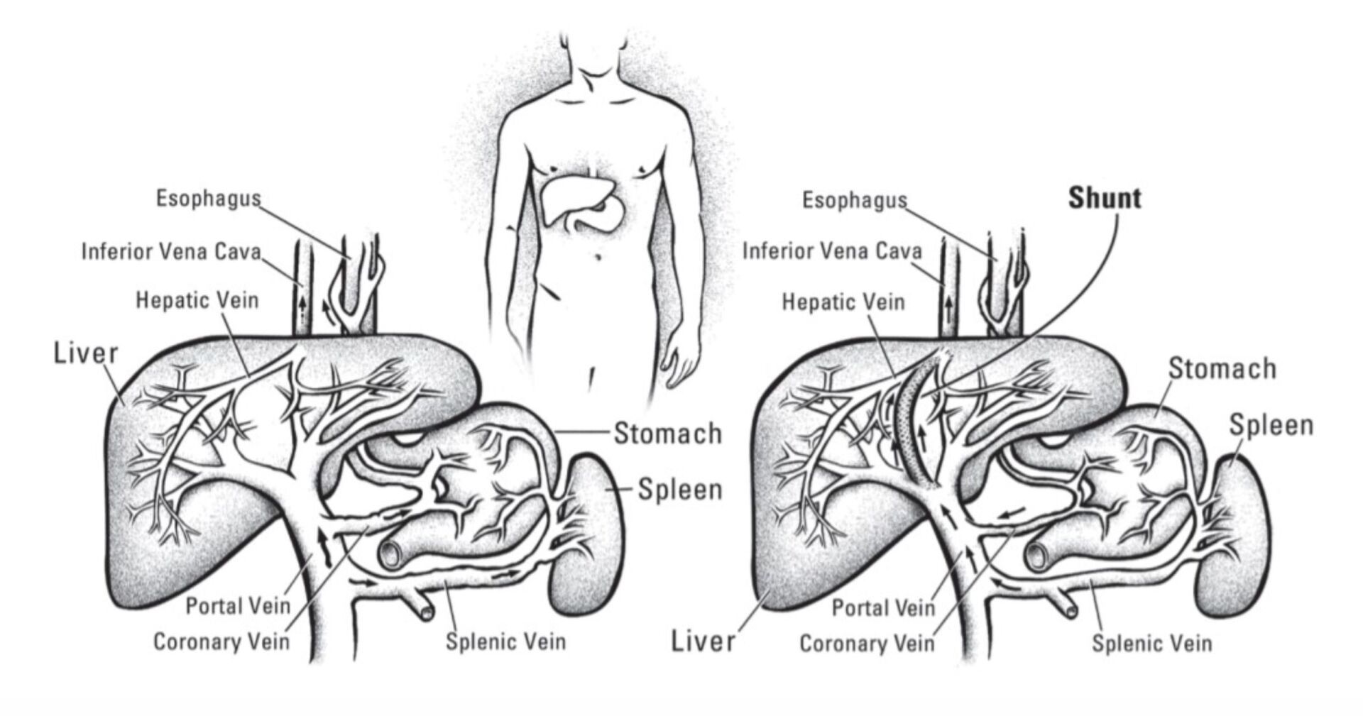 Illustration of TIPS placement between the portal vein and hepatic vein