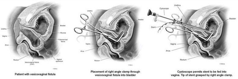 Laparoscopic Vesicovaginal Fistula (VVF) Surgery Typical image of Laparoscopic Vesicovaginal Fistula (VVF) surgery