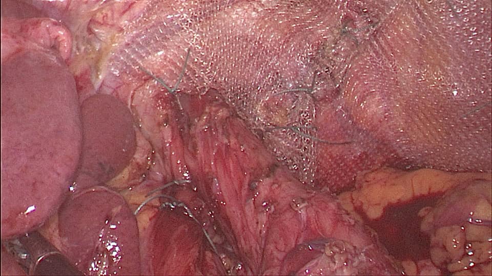Image of Bochdalek Hernia