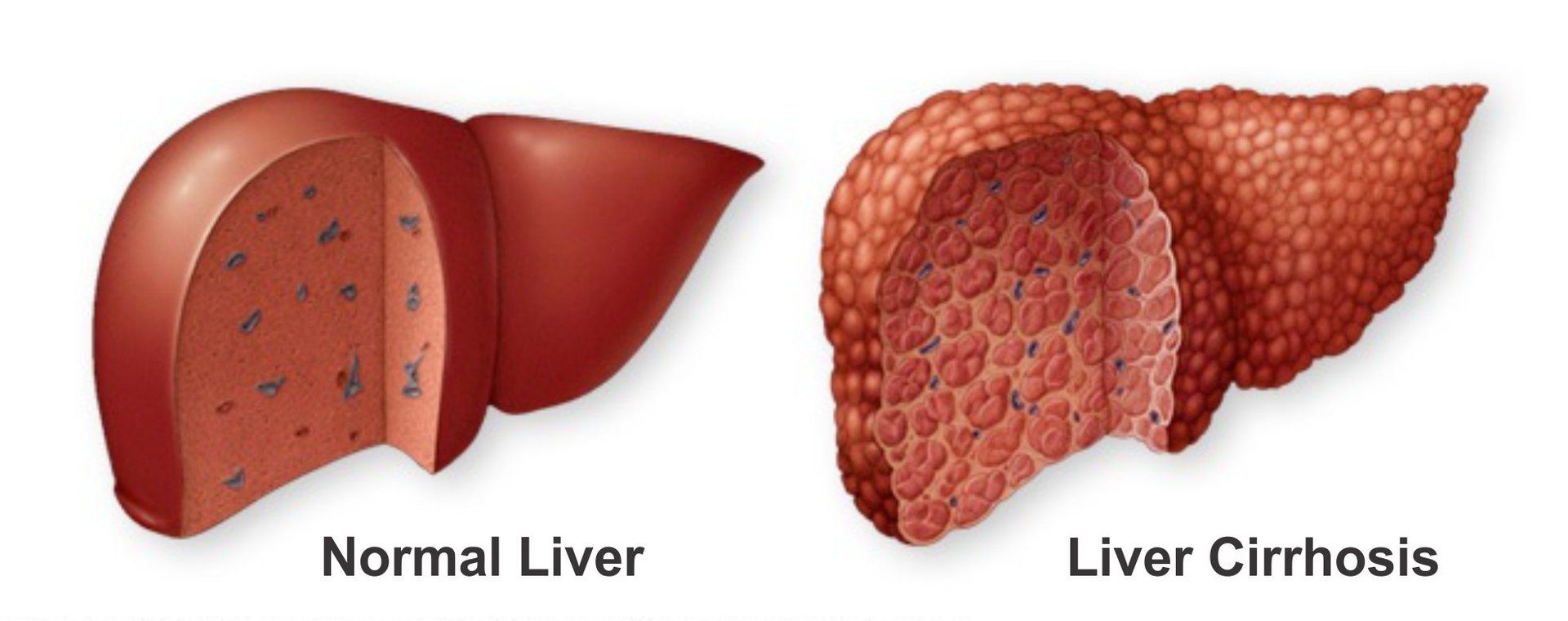 Comparison of Normal Liver and Liver Cirrhosis Comparison of Normal Liver and Liver Cirrhosis