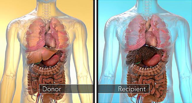Live-donor liver transplant | Pace Hospitals
