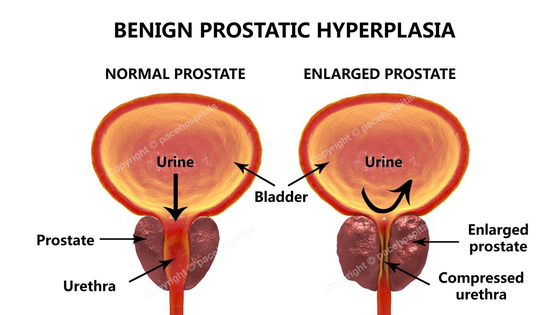 Normal and Enlarged Prostate (Benign prostatic hyperplasia) Normal and Enlarged Prostate (Benign prostatic hyperplasia)