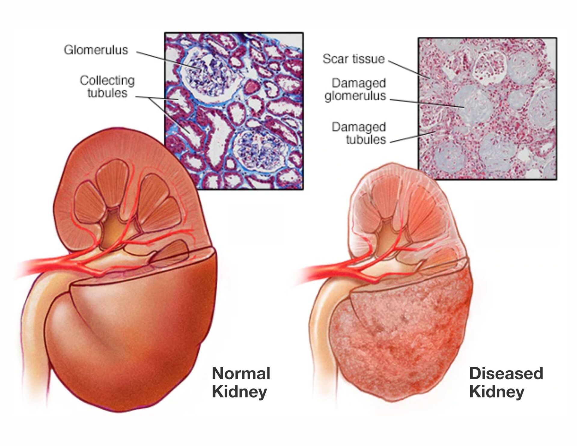Normal Kidney and Diseased Kidney - Pace Hospitals