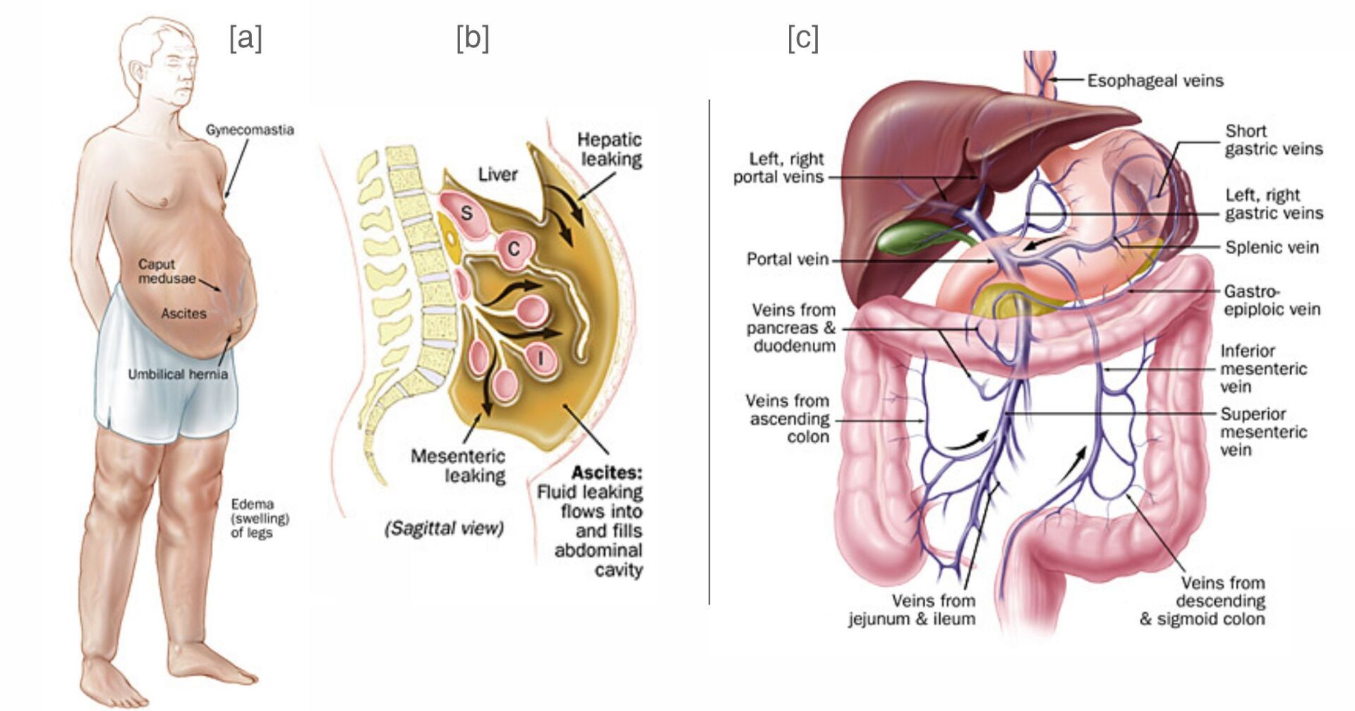 Portal Hypertension Anatomy and Ascites Portal Hypertension Anatomy and Ascites