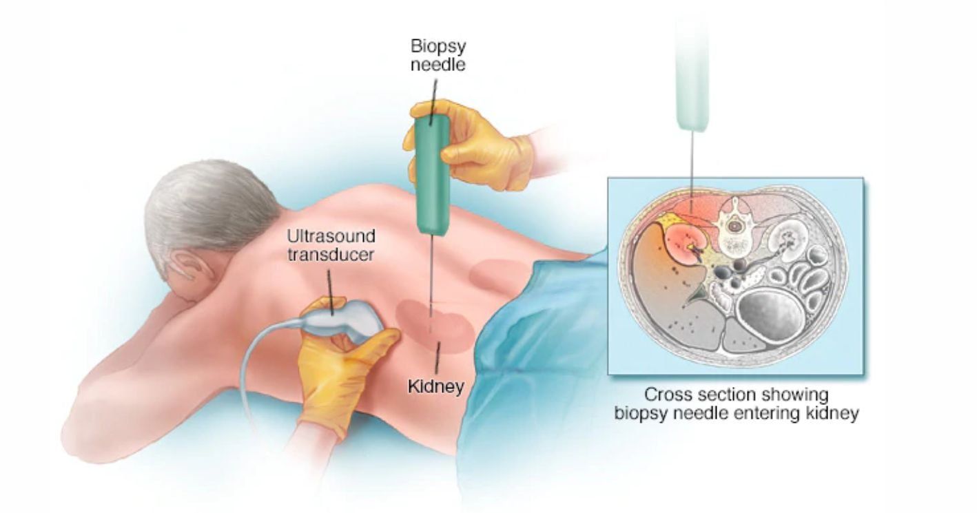 Kidney Biopsy : Indications, Preparation and Procedure Kidney Biopsy : Indications, Preparation and Procedure