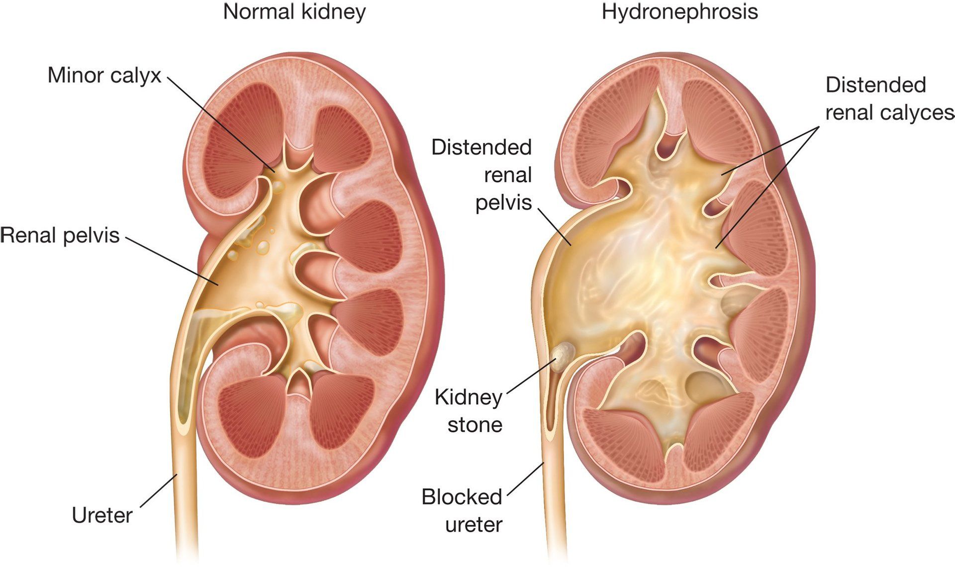 Pyeloplasty for children with UPJ obstruction
