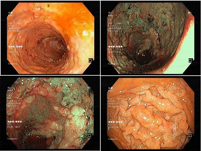 45 years male with Ulcerative Colitis since 4 years