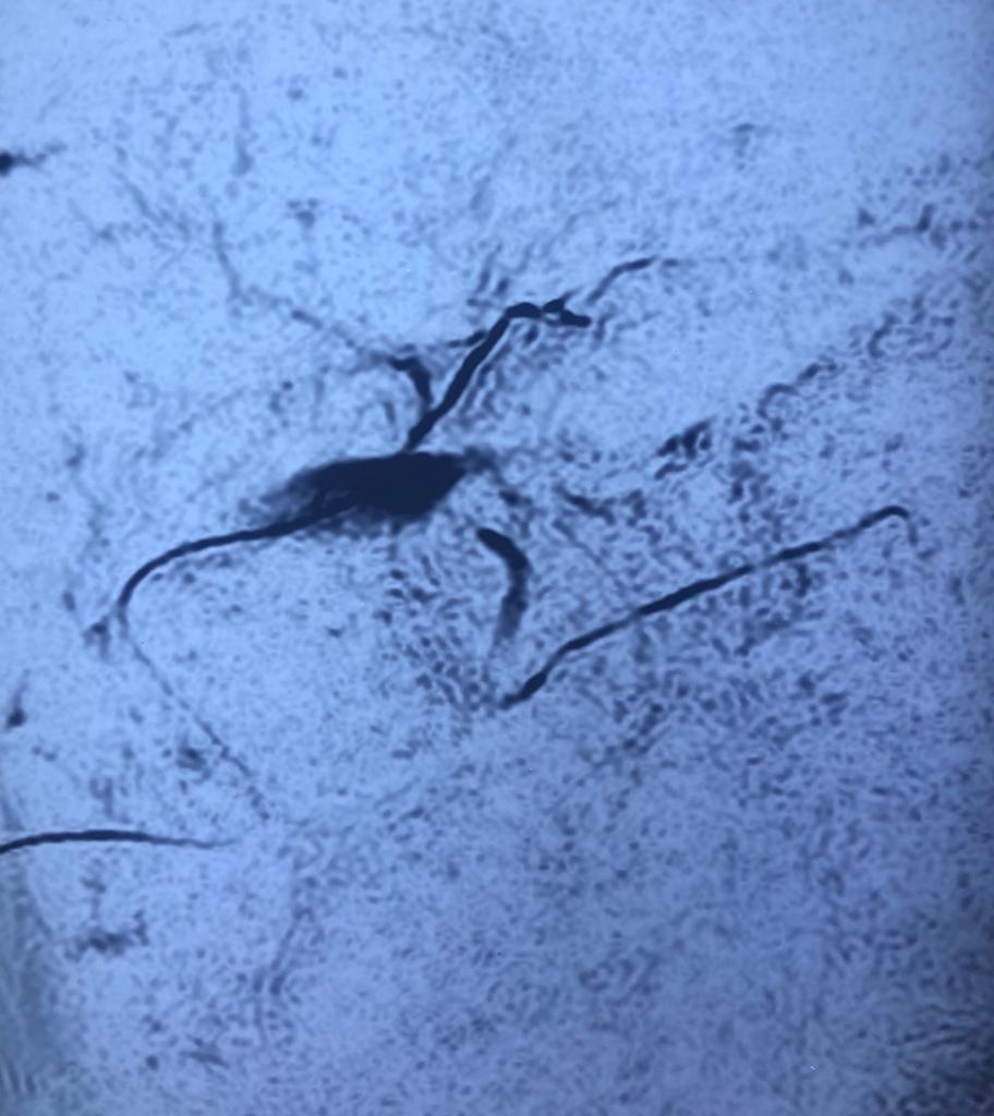 post cholecystectomy biliary stricture with complete cutoff and external biliary fistula