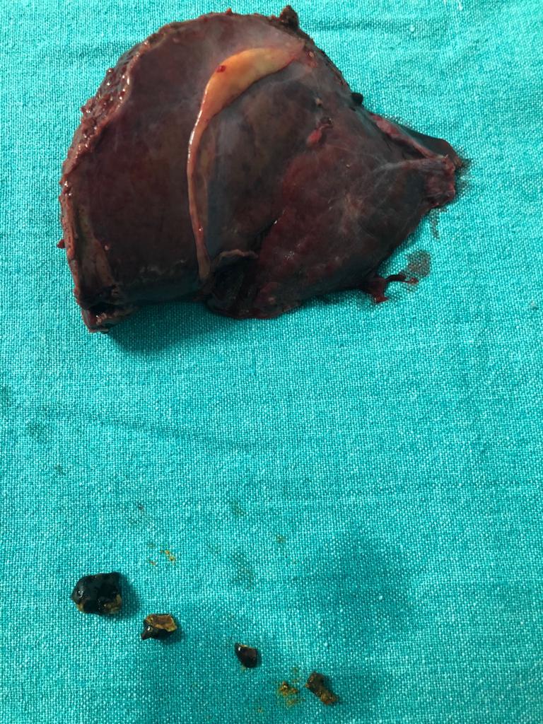 RPC with Jaundice and fever case study