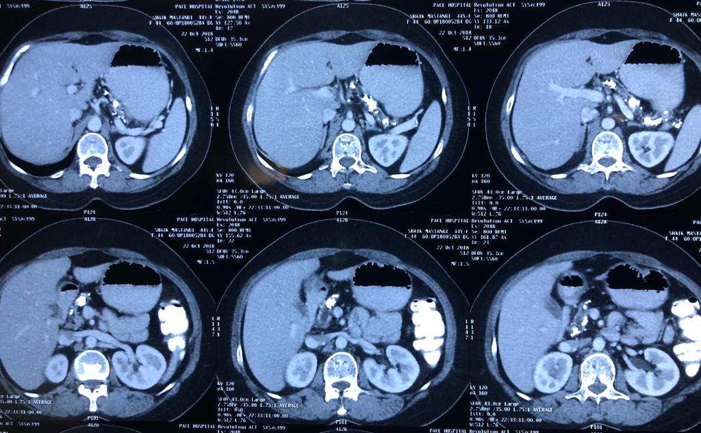 CT scan showed dilated PD 12 mm with large calculi
