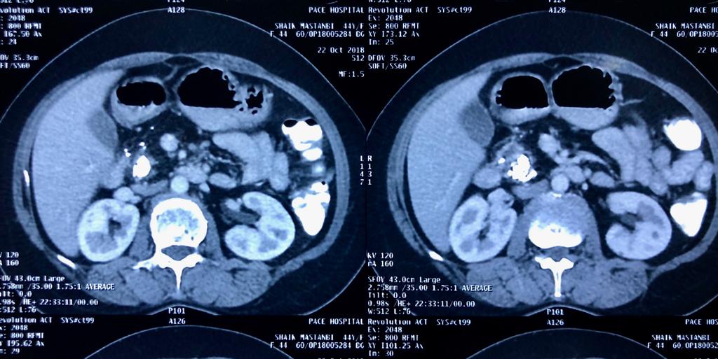 CT scan showed dilated PD 12 mm with large calculi