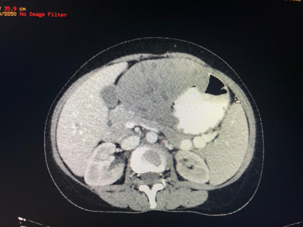Gastric schwannoma is a very rare mesenchymal tumor