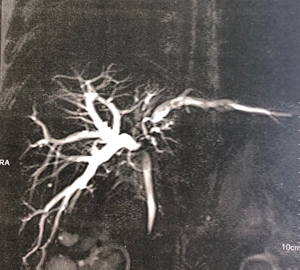 bile duct excision and right hepaticojejunostomy