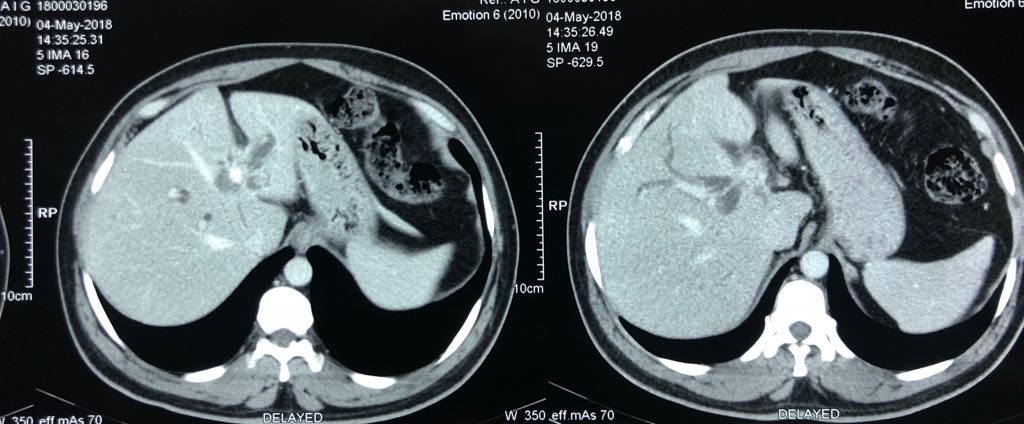 bile duct excision and right hepaticojejunostomy