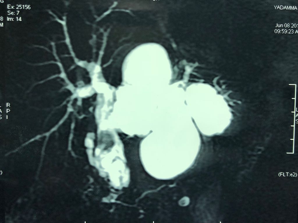 diagnosis of recurrent hydatid cyst