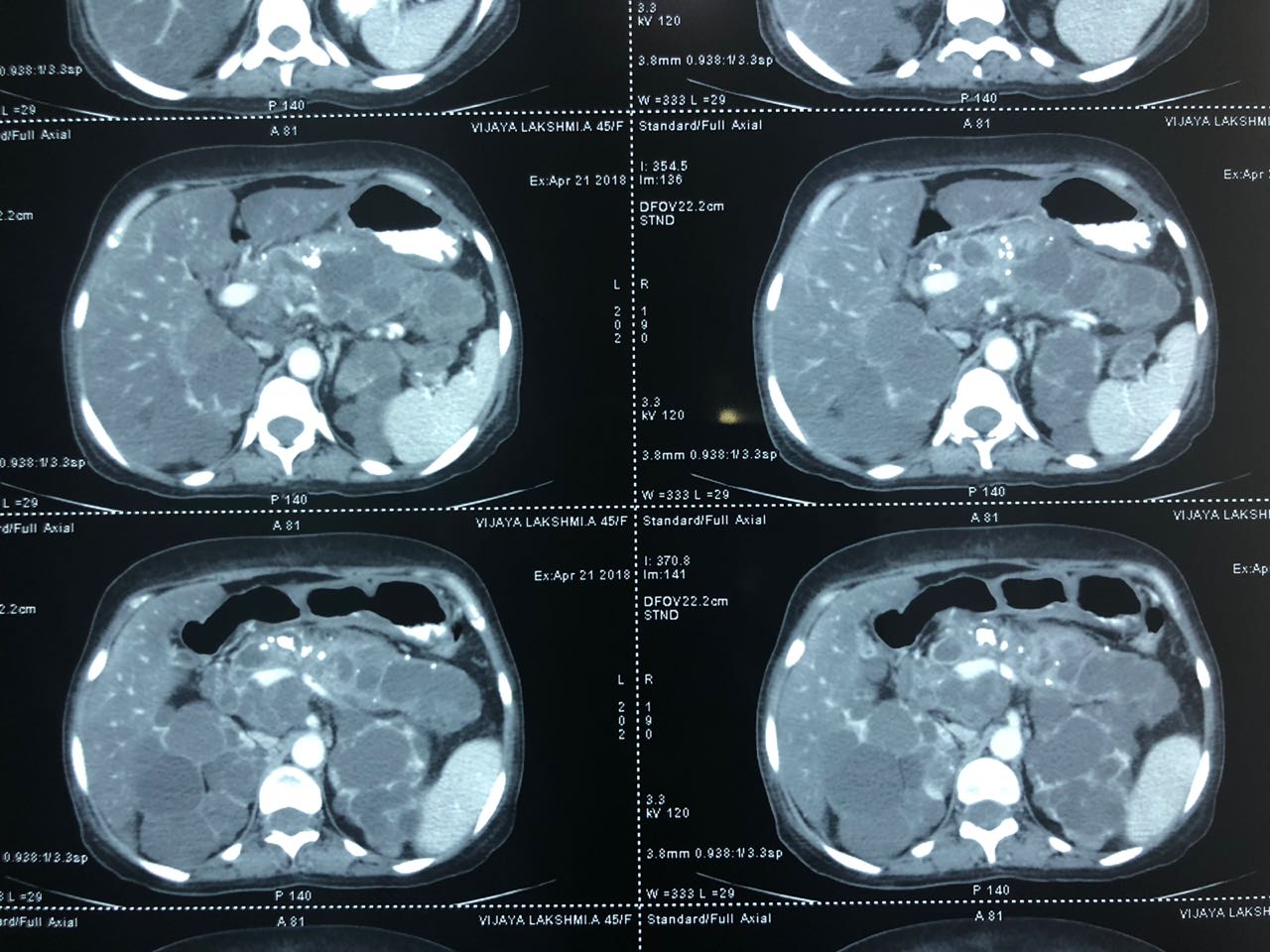 Total pancreaticoduodenectomy with splenectomy