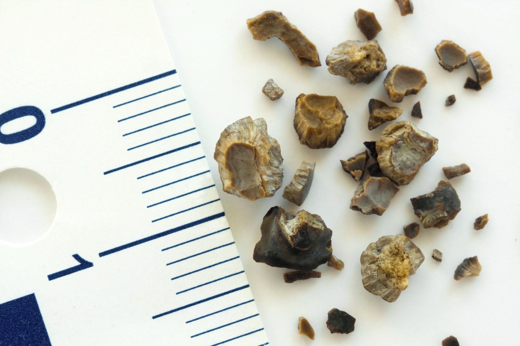 What are the causes for Kidney Stone Causes? What are the causes for Kidney Stone Causes?