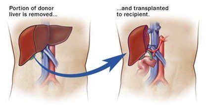 Liver Transplant Donor Surgery Process Liver Transplant Donor Surgery Process explained through visual presentation