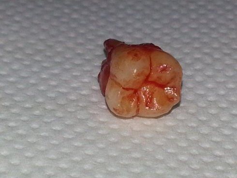 Asportazione denti